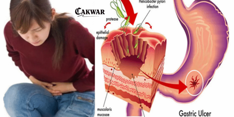 Mengenal Penyakit GERD, Gejala, Penanganan, Bahaya, dan Obat yang Disarankan