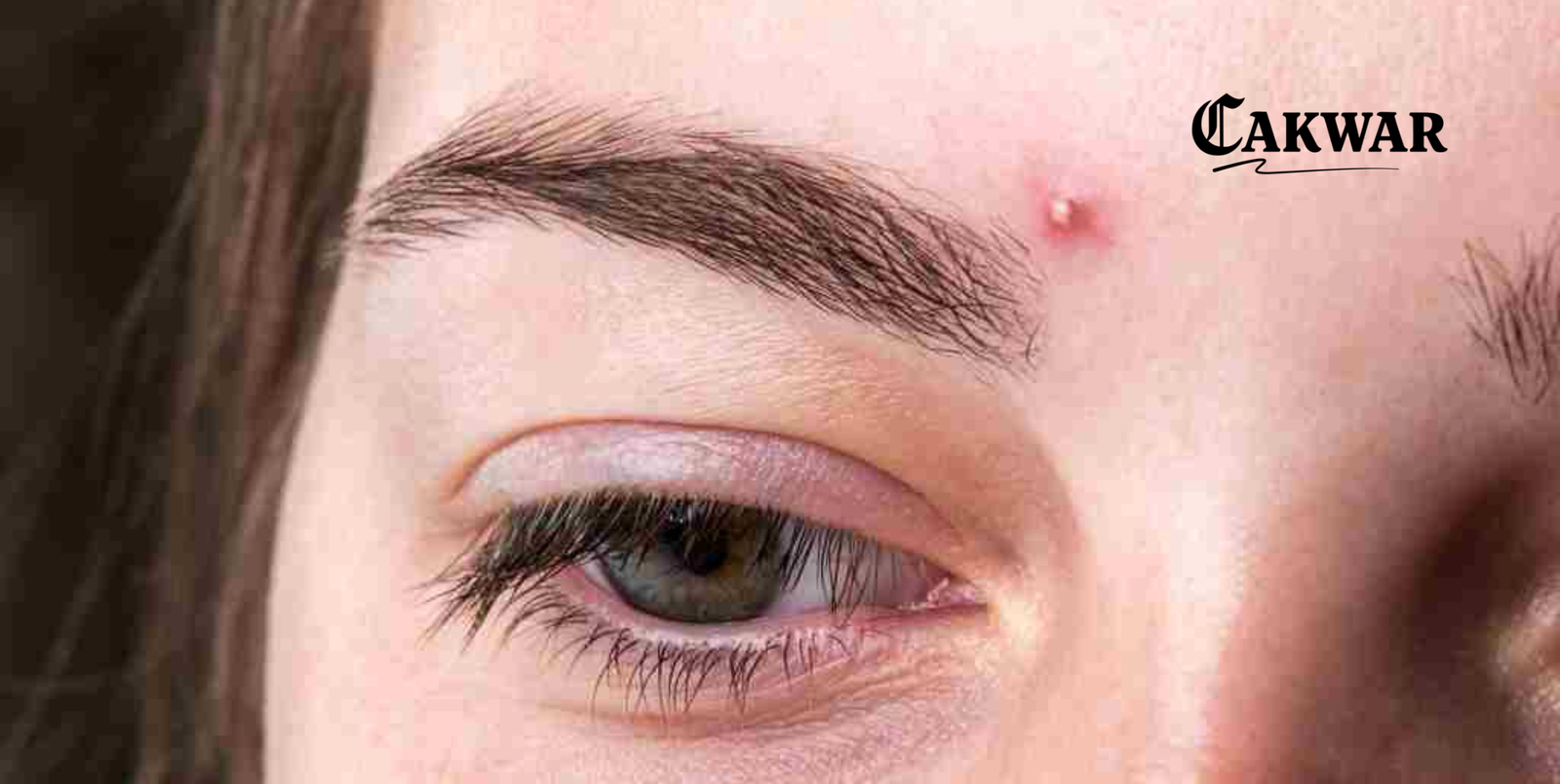 Kenapa Jerawat Bisa Muncul? Ini Alasan yang Sering Kita Nggak Sadari